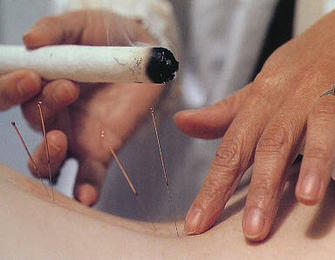 Acupuncture Dun Laoghaire | Acupuncture Ratoath